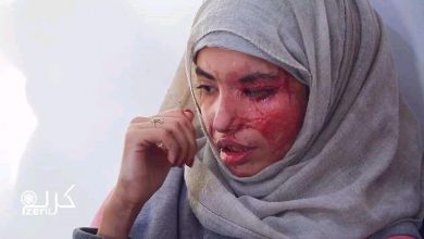 Photo of رش مادة الأسيد على طفلة في صنعاء